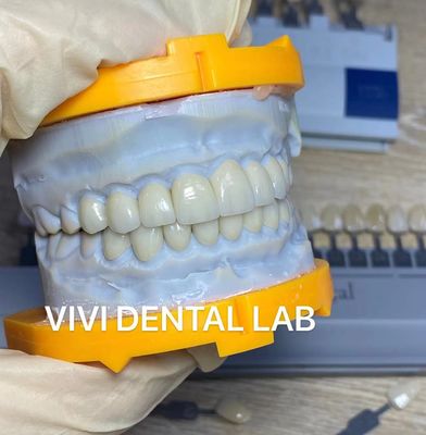 Высокий астетический ламинат Emax зубов лощит лабораторию Китая Incisal Translucency зубоврачебную